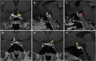 Double pituitary adenomas: report of two cases and systematic review of the literature